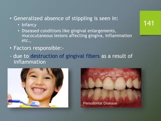 141
• Generalized absence of stippling is seen in:
• Infancy
• Diseased conditions like gingival enlargements,
mucocutaneous lesions affecting gingiva, inflammation
etc.,
• Factors responsible:-
- due to destruction of gingival fibers as a result of
inflammation
 