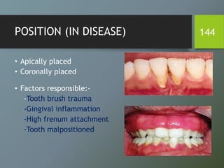 POSITION (IN DISEASE)
• Apically placed
• Coronally placed
• Factors responsible:-
-Tooth brush trauma
-Gingival inflammation
-High frenum attachment
-Tooth malpositioned
144
 