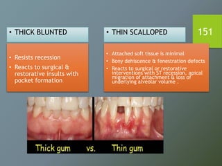 151• THICK BLUNTED
• Resists recession
• Reacts to surgical &
restorative insults with
pocket formation
• THIN SCALLOPED
• Attached soft tissue is minimal
• Bony dehiscence & fenestration defects
• Reacts to surgical or restorative
interventions with ST recession, apical
migration of attachment & loss of
underlying alveolar volume .
 