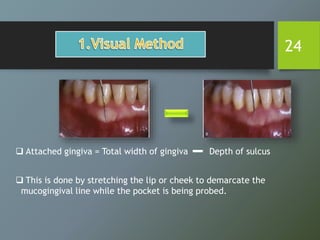 24
 Attached gingiva = Total width of gingiva Depth of sulcus
 This is done by stretching the lip or cheek to demarcate the
mucogingival line while the pocket is being probed.
 