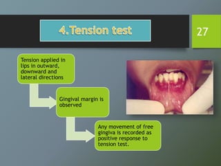 27
Tension applied in
lips in outward,
downward and
lateral directions
Gingival margin is
observed
Any movement of free
gingiva is recorded as
positive response to
tension test.
 