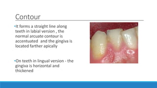 Contour
•It forms a straight line along
teeth in labial version , the
normal arcuate contour is
accentuated and the gingiva is
located farther apically
•On teeth in lingual version - the
gingiva is horizontal and
thickened
 