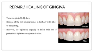 REPAIR / HEALING OF GINGIVA
• Turnover rate is 10-12 days.
• It is one of the best healing tissues in the body with little
or no scarring.
• However, the reparative capacity is lesser than that of
periodontal ligament and epithelial tissue.
 
