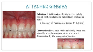 Definition: It is firm & resilient gingiva, tightly
bound to the underlying periosteum of alveolar
bone.
( Glossary of Periodontal terms,4th Edition)
Demarcation: It extends to the relatively loose and
movable alveolar mucosa, from which it is
demarcated by the mucogingival junction.
c
 