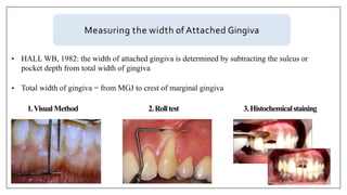 Measuring the width of Attached Gingiva
1.Visual Method
• HALL WB, 1982: the width of attached gingiva is determined by subtracting the sulcus or
pocket depth from total width of gingiva
• Total width of gingiva = from MGJ to crest of marginal gingiva
2.Rolltest 3.Histochemicalstaining
 