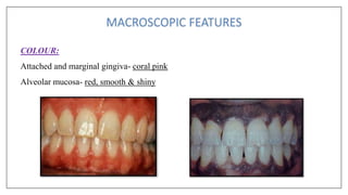 COLOUR:
Attached and marginal gingiva- coral pink
Alveolar mucosa- red, smooth & shiny
 