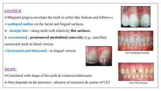 CONTOUR:
Marginal gingiva envelops the teeth in collar-like fashion and follows a
scalloped outline on the facial and lingual surfaces.
 straight line - along teeth with relatively flat surfaces.
 accentuated - pronounced mesiodistal convexity (e.g., maxillary
canines)on teeth in labial version.
horizontal and thickened - in lingual version.
SHAPE:
Correlated with shape of the teeth & contacts/embrasures.
Also depends on the presence / absence of recession & course of CEJ.
 