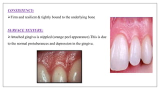 CONSISTENCY:
Firm and resilient & tightly bound to the underlying bone
SURFACE TEXTURE:
Attached gingiva is stippled (orange peel appearance).This is due
to the normal protuberances and depression in the gingiva.
 