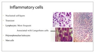 Inflammatory cells
• Nucleated cell layers
• Transient
• Lymphocytes: Most frequent
Associated with Langerhans cells
• Polymorphonuclear leukocytes
• Mast cells
 