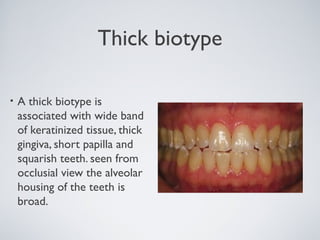 Gingiva biotype | PPT