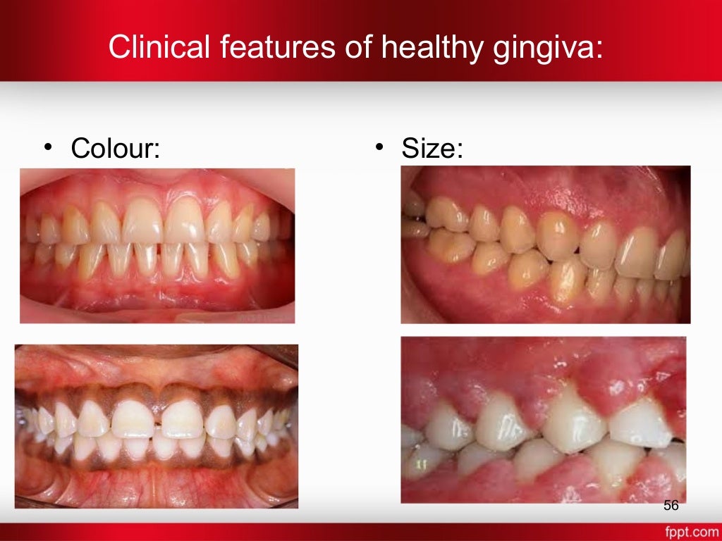 Gingiva in health and disease