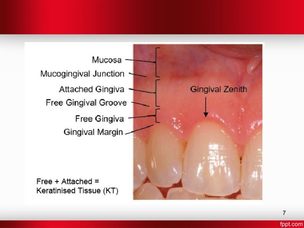 Gingiva in health and disease