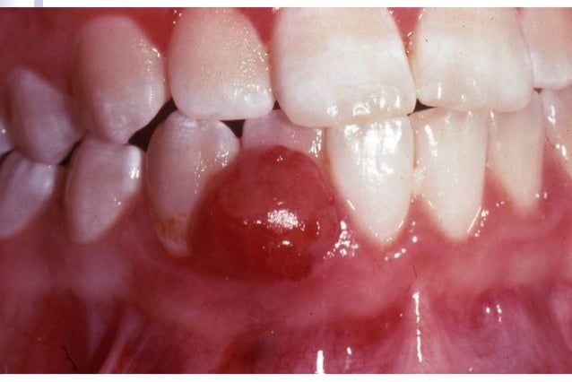 Gingivaland papillary.comp
