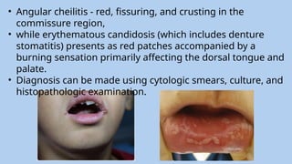 Gingival and Periodontal diseases in children pediatric dentistry .pptx