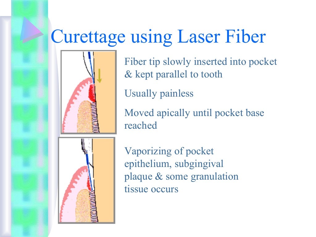 Gingival curettage 1