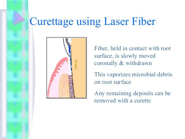 gingival curettage