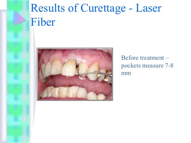 gingival curettage