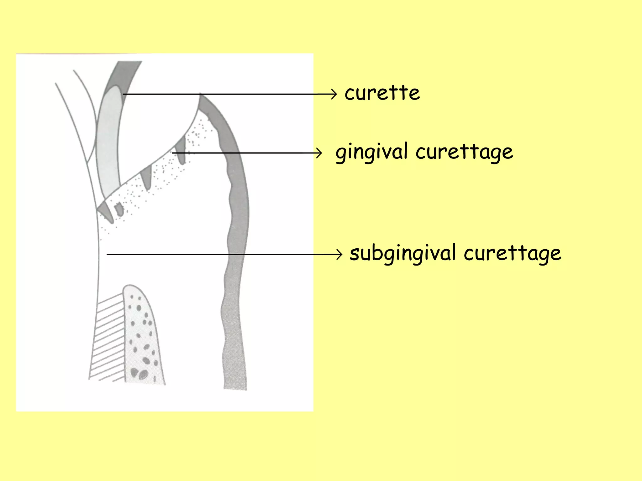 Gingival curettage PPT