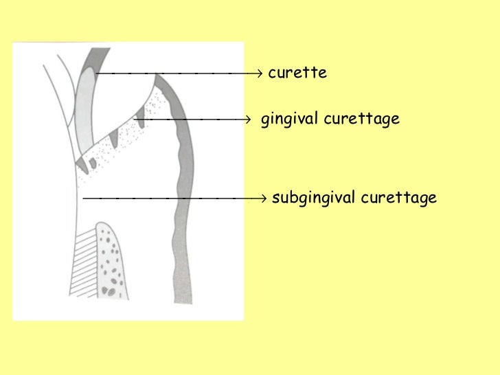 Gingival curettage