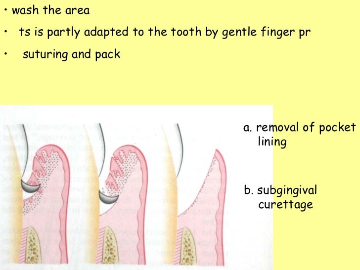 Gingival curettage