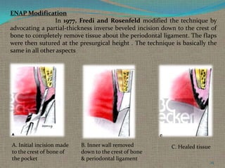 ENAP Modification
In 1977, Fredi and Rosenfeld modified the technique by
advocating a partial-thickness inverse beveled incision down to the crest of
bone to completely remove tissue about the periodontal ligament. The flaps
were then sutured at the presurgical height . The technique is basically the
same in all other aspects

A. Initial incision made
to the crest of bone of
the pocket

B. Inner wall removed
down to the crest of bone
& periodontal ligament

C. Healed tissue
25

 