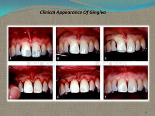 Clinical Appearance Of Gingiva

29

 