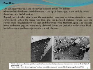 Zero Hour.
The connective tissue at the sulcus was exposed and in few animals
when epithelial cells remained they were at the tip of the margin, at the middle area of
the sulcus or at both locations.
Beyond the epithelial attachment the connective tissue was sometimes torn from overcurettement. When the tissue was torn and the perfused material flowed into the
sulcus, more vascularization was seen and there was some Hemorrhaging. The capillary
loops in the rete peg area were easily observed due to the perfusion with carbon black.
No inflammatory cells were present in the sulcular area.

31

 