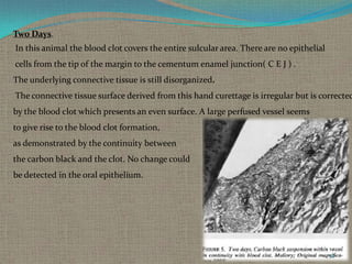 Two Days.
In this animal the blood clot covers the entire sulcular area. There are no epithelial
cells from the tip of the margin to the cementum enamel junction( C E J ) .
The underlying connective tissue is still disorganized.

The connective tissue surface derived from this hand curettage is irregular but is corrected
by the blood clot which presents an even surface. A large perfused vessel seems
to give rise to the blood clot formation,
as demonstrated by the continuity between
the carbon black and the clot. No change could

be detected in the oral epithelium.

32

 