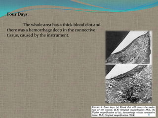 Four Days.
The whole area has a thick blood clot and
there was a hemorrhage deep in the connective
tissue, caused by the instrument.

33

 