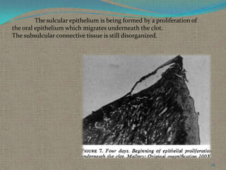 The sulcular epithelium is being formed by a proliferation of
the oral epithelium which migrates underneath the clot.
The subsulcular connective tissue is still disorganized.

34

 