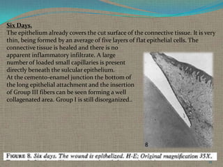 Six Days.
The epithelium already covers the cut surface of the connective tissue. It is very
thin, being formed by an average of five layers of flat epithelial cells. The
connective tissue is healed and there is no
apparent inflammatory infiltrate. A large
number of loaded small capillaries is present
directly beneath the sulcular epithelium.
At the cemento-enamel junction the bottom of
the long epithelial attachment and the insertion
of Group III fibers can be seen forming a well
collagenated area. Group I is still disorganized..

35

 