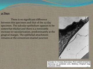 31 Days.
There is no significant difference
between this specimen and that of the 23-day
specimen. The sulcular epithelium appears to be
somewhat thicker and there is a noticeable
increase in vascularization, predominantly at the
gingival margin. The epithelial attachment
remains at the cementum enamel junction

42

 