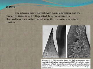 38 Days.
The sulcus remains normal, with no inflammation, and the
connective tissue is well collagenated. Fewer vessels can be
observed here than in the control, since there is no inflammatory
reaction.

43

 