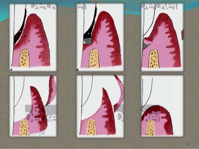 gingival curettage