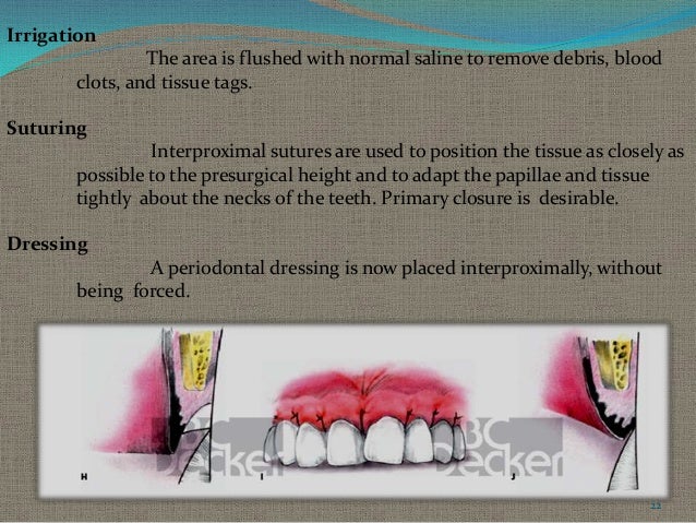 gingival curettage