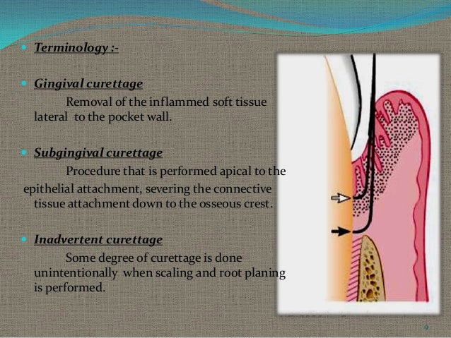 gingival curettage