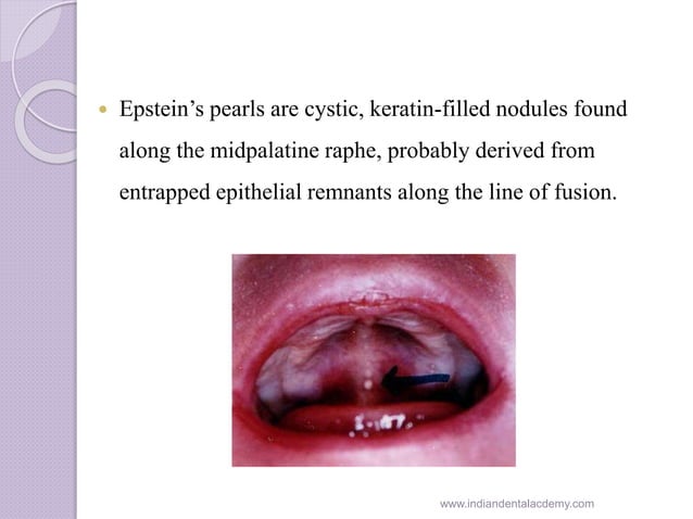Gingival cyst of newborn /orthodontic courses by Indian dental academy