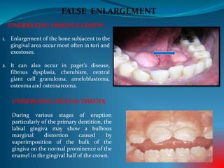 FALSE ENLARGEMENT
UNDERLYING OSSEOUS LESION
1. Enlargement of the bone subjacent to the
gingival area occur most often in tori and
exostoses.
2. It can also occur in paget’s disease,
fibrous dysplasia, cherubism, central
giant cell granuloma, ameloblastoma,
osteoma and osteosarcoma.
UNDERLYING DENTAL TISSUES
During various stages of eruption
particularly of the primary dentition, the
labial gingiva may show a bulbous
marginal distortion caused by
superimposition of the bulk of the
gingiva on the normal prominence of the
enamel in the gingival half of the crown.
 