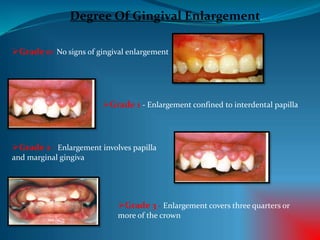 Degree Of Gingival Enlargement
Grade 0- No signs of gingival enlargement
Grade 1 - Enlargement confined to interdental papilla
Grade 2 - Enlargement involves papilla
and marginal gingiva
Grade 3 - Enlargement covers three quarters or
more of the crown
 