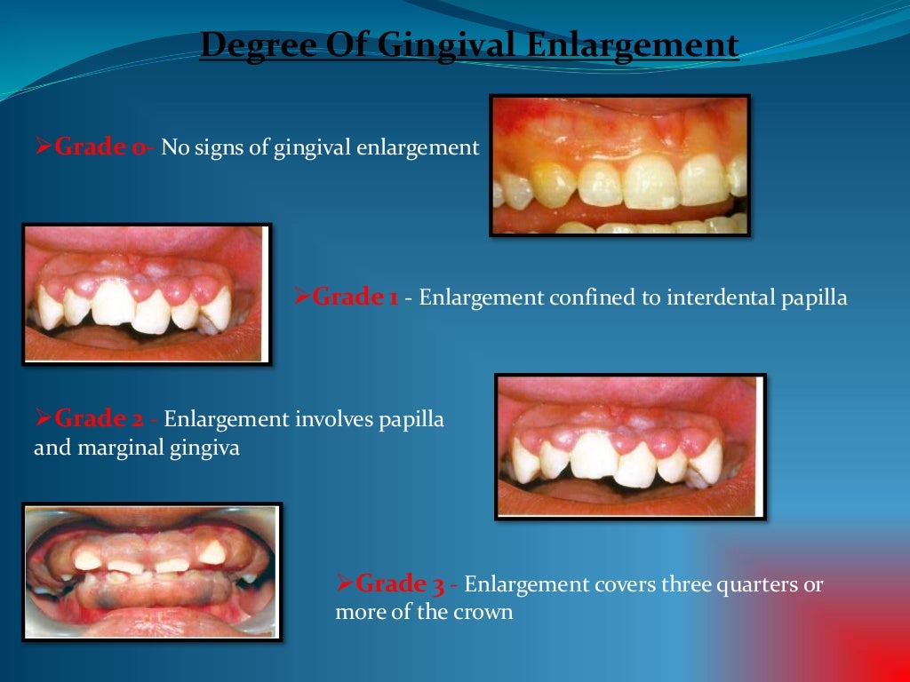 Gingival enlargement