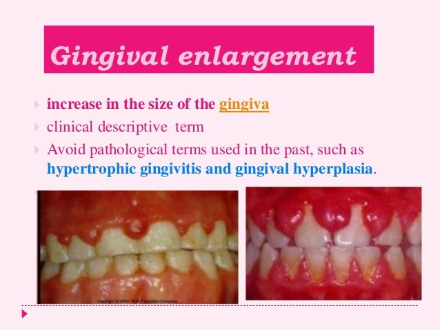 Gingival Enlargement