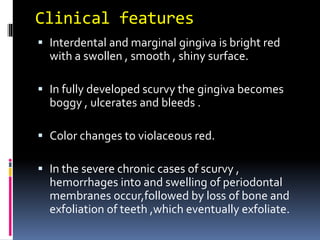 Gingival Enlargement- II.pp