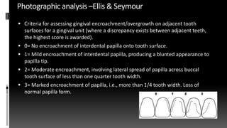 Photographic analysis –Ellis & Seymour
 Criteria for assessing gingival encroachment/overgrowth on adjacent tooth
surfaces for a gingival unit (where a discrepancy exists between adjacent teeth,
the highest score is awarded).
 0= No encroachment of interdental papilla onto tooth surface.
 1= Mild encroachment of interdental papilla, producing a blunted appearance to
papilla tip.
 2= Moderate encroachment, involving lateral spread of papilla across buccal
tooth surface of less than one quarter tooth width.
 3= Marked encroachment of papilla, i.e., more than 1/4 tooth width. Loss of
normal papilla form.
 