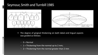 Seymour, Smith and Turnbill 1985
 The degree of gingival thickening on both labial and lingual aspects
was graded as follows:
 0 = Normal
 1 = Thickening from the normal up to 2 mm;
 2 = Thickening from the normal greater than 2 mm
 