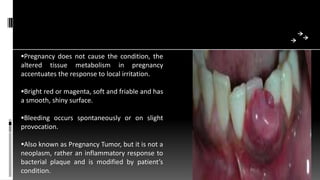 Pregnancy does not cause the condition, the
altered tissue metabolism in pregnancy
accentuates the response to local irritation.
Bright red or magenta, soft and friable and has
a smooth, shiny surface.
Bleeding occurs spontaneously or on slight
provocation.
Also known as Pregnancy Tumor, but it is not a
neoplasm, rather an inflammatory response to
bacterial plaque and is modified by patient’s
condition.
 