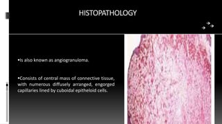 HISTOPATHOLOGY
Is also known as angiogranuloma.
Consists of central mass of connective tissue,
with numerous diffusely arranged, engorged
capillaries lined by cuboidal epitheloid cells.
 