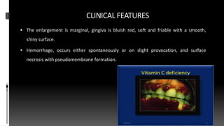 CLINICAL FEATURES
 The enlargement is marginal, gingiva is bluish red, soft and friable with a smooth,
shiny surface.
 Hemorrhage, occurs either spontaneously or on slight provocation, and surface
necrosis with pseudomembrane formation.
 