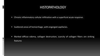 HISTOPATHOLOGY
 Chronic inflammatory cellular infiltration with a superficial acute response.
 Scattered areas of hemorrhage, with engorged capillaries.
 Marked diffuse edema, collagen destruction, scarcity of collagen fibers are striking
features
 