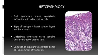 HISTOPATHOLOGY
 Oral epithelium shows spongiosis,
infiltration with inflammatory cells.
 Signs of damage in lower spinous layers
and basal layers.
 Underlying connective tissue contains
dense infiltrate of plasma cells.
 Cessation of exposure to allergens brings
about resolution of the lesion.
 