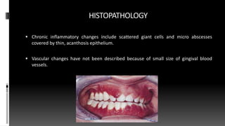 HISTOPATHOLOGY
 Chronic inflammatory changes include scattered giant cells and micro abscesses
covered by thin, acanthosis epithelium.
 Vascular changes have not been described because of small size of gingival blood
vessels.
 